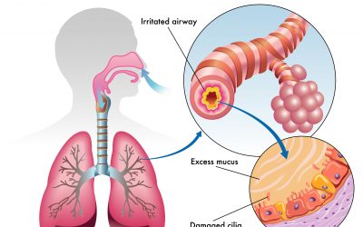 How Serious Is Bronchitis?